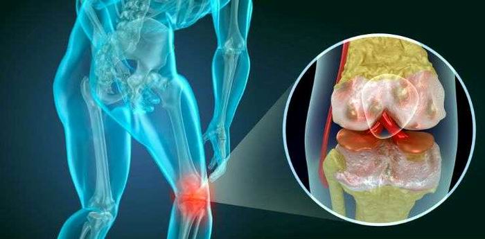 ¿Qué hacer cuando duelen las rodillas?