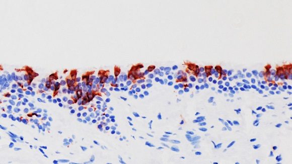 La variante omicrón del coronavirus (en rojo) infectando tejidos de bronquios humanos. Foto: University of Hong Kong