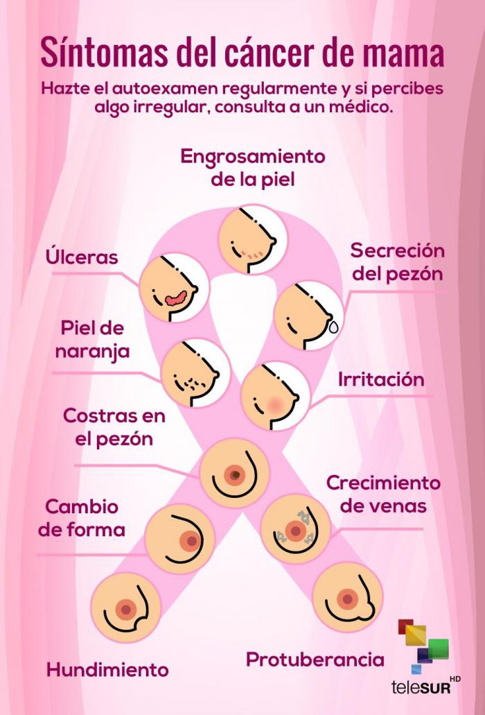 Síntomas del cáncer de mamas