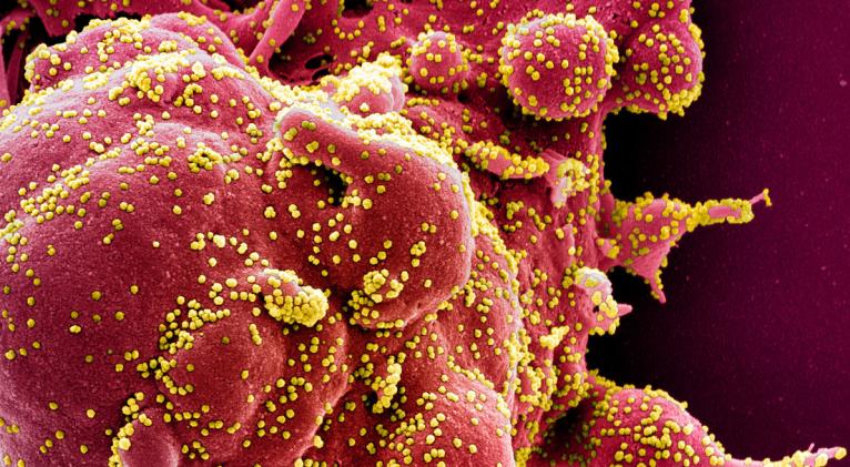 Microfotografía electrónica coloreada de una célula atacada por el SARS-CoV-2. National Institute of Allergy and Infectious Diseases, NIH/Handout / Reuters